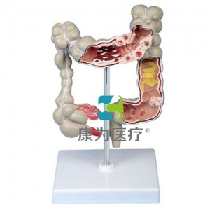 “康为医疗”大肠病变模型