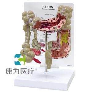 “康为医疗”医患关系沟通模型-病理结肠模型 （医学指导模型）