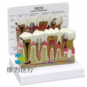 “康为医疗”医患关系沟通模型-前磨牙和臼齿放大模型（医学指导模型）