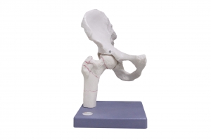 股骨骨折模型