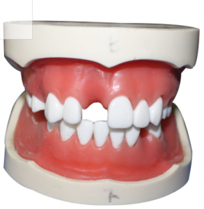 种植牙模型（含上、下颌）