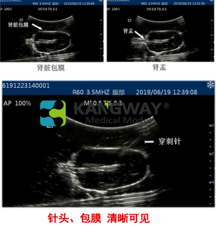 超声引导下肾脏穿刺术训练模块